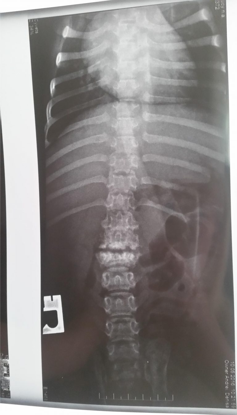 Spine Fracture Radiography 2